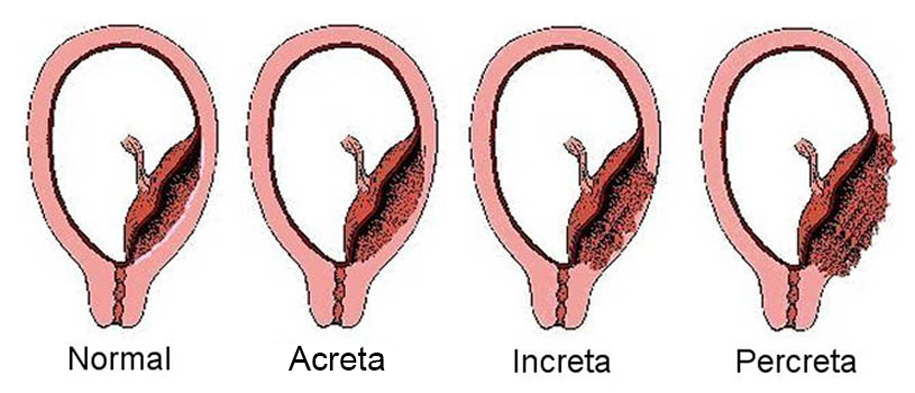 acretismo-placentario